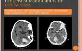 Микрокровоизлияния в левой гемисфере мозжечка