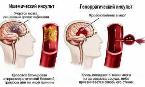По каким причинам возникает инсульт головного мозга