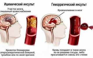 По каким причинам возникает инсульт головного мозга