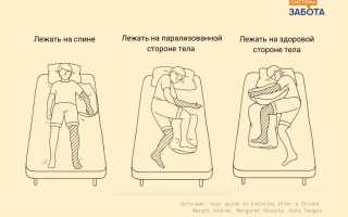 Как лфк помогает восстановиться после инсульта