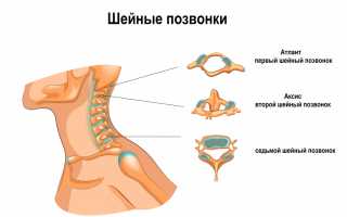 Боли в шейном отделе при повороте головы