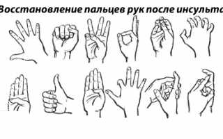 Восстановление движения рук после инсульта