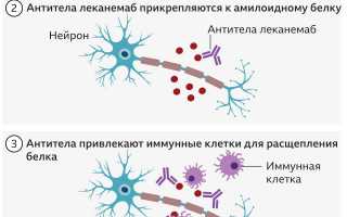 Насколько реально лечение тяжелой болезни Альцгеймера