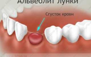 Выпала ватка из лунки зуба