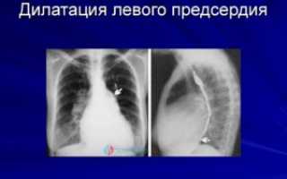 Дилатация левого предсердия