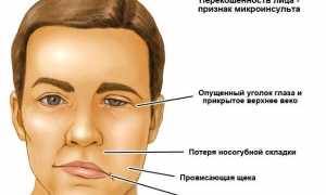 Последствия после микроинсульта