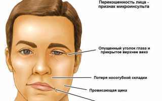 Последствия после микроинсульта