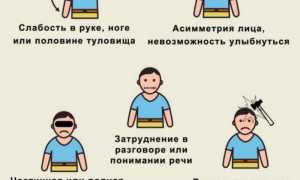 Определение инсульта по неврологическим симптомам