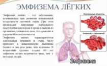 Эмфизема легких, хрип и бульканье в лежачем положении