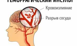 Когда возникает геморроидальный или геморрагический инсульт