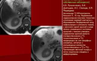 Мезентериальный панникулит насколько опасно?