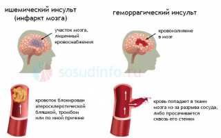 Восстановление речи после перенесенного инсульта