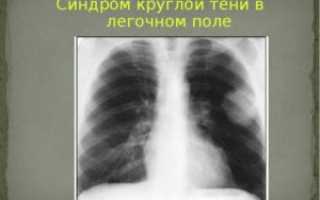 Дополнительная тень в легких