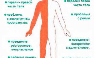 Какие можно получить последствия во время инсульта левой стороны