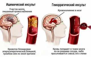 Признаки и лечение алкогольной энцефалопатии 2 стадии