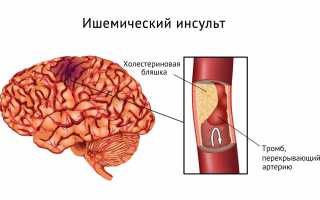Что представляет из себя инсульт и чем он опасен