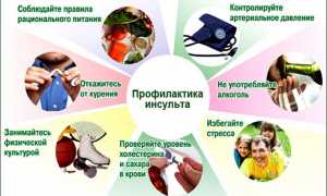 Как предотвратить повторный инсульт