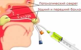Что делать если болит голова при гайморите