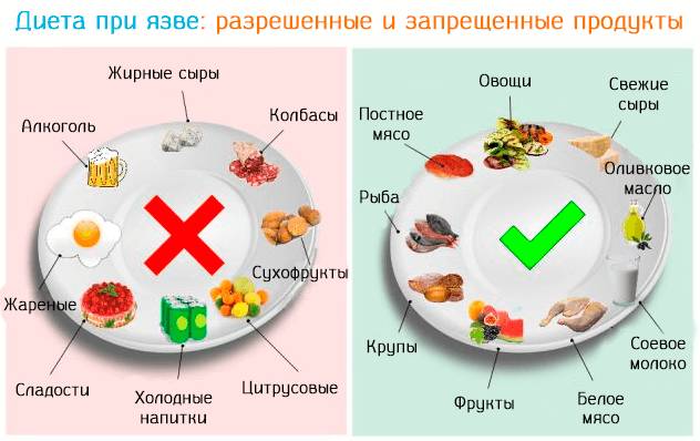Питание в период ремиссии при язве